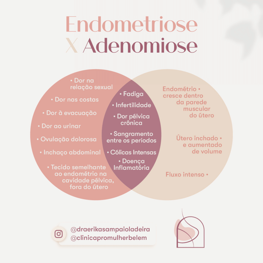 Endometriose X Adenomiose Cl Nica Pr Mulher Bel M